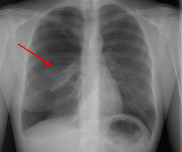 Pneumothorax - Causes, Signs, Symptoms, Treatment