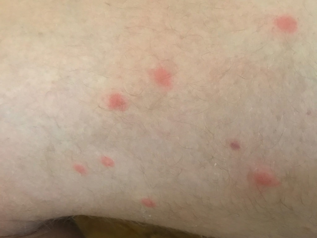 Swimmers itch cause apgor