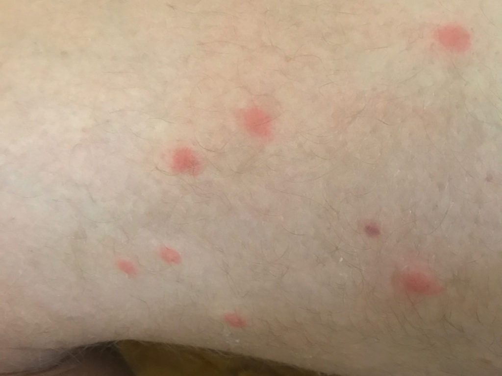 mild swimmers itch pictures