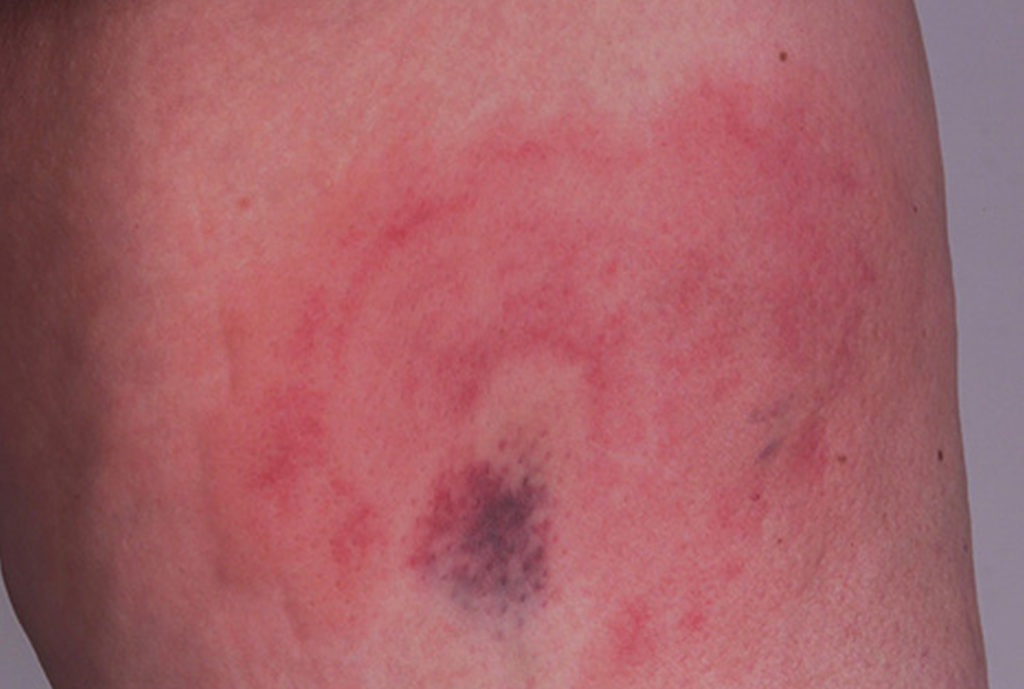 Urticarial Vasculitis Types Causes Symptoms Treatment 