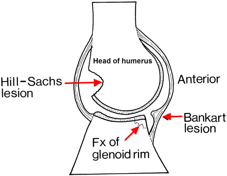 Dislocated Shoulder - Causes, Signs, Symptoms, How To Fix