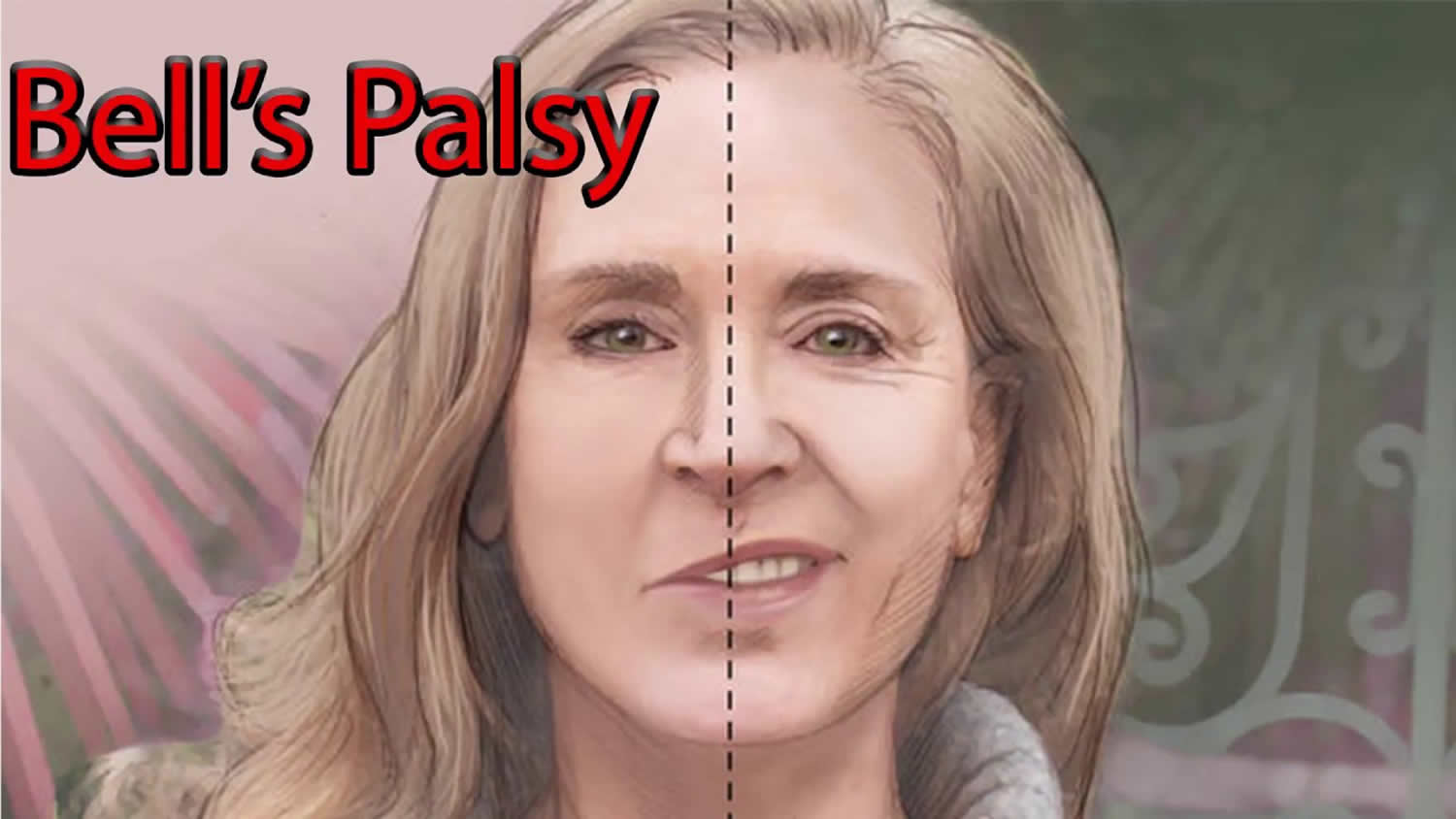 Bell s Palsy Causes Symptoms Diagnosis Recovery Treatment
