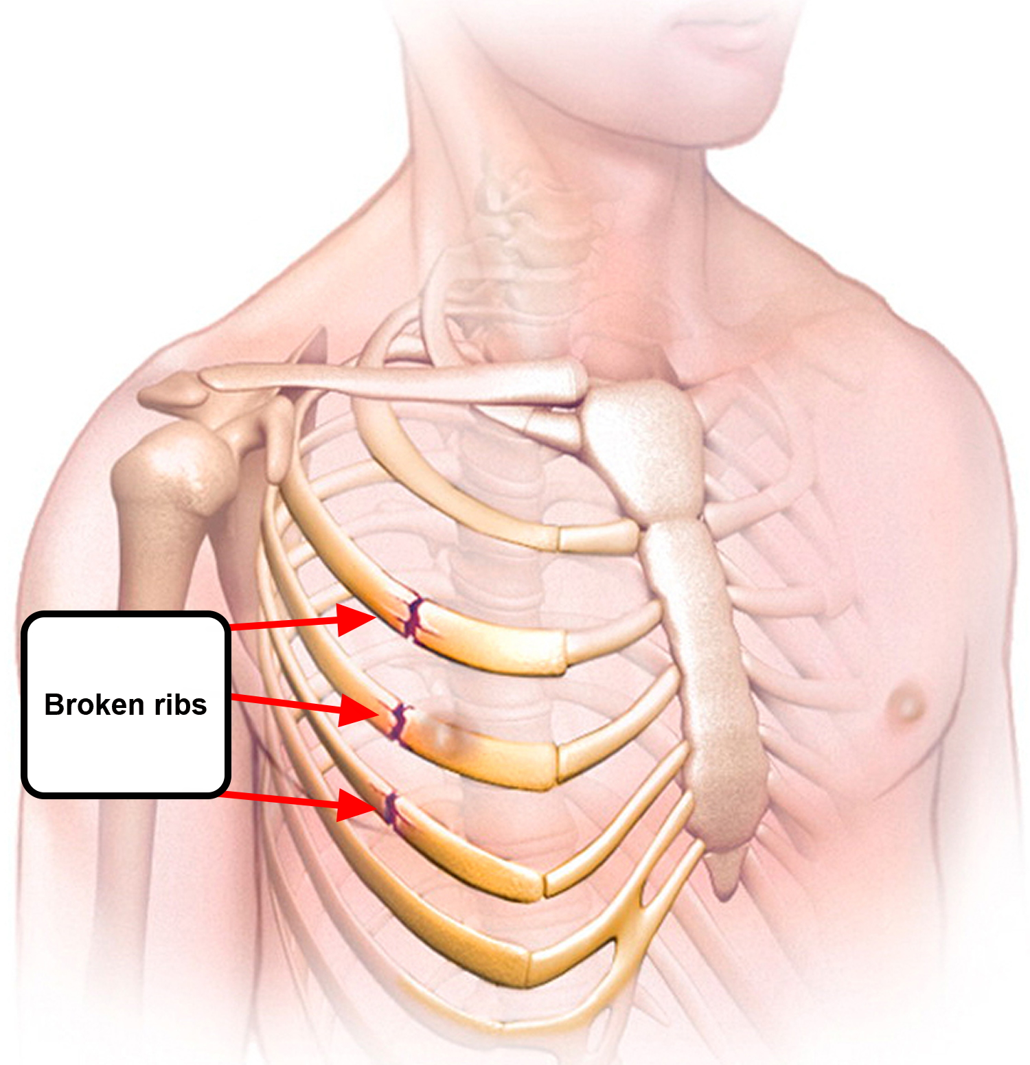 broken-rib-causes-signs-symptoms-recovery-time-treatment