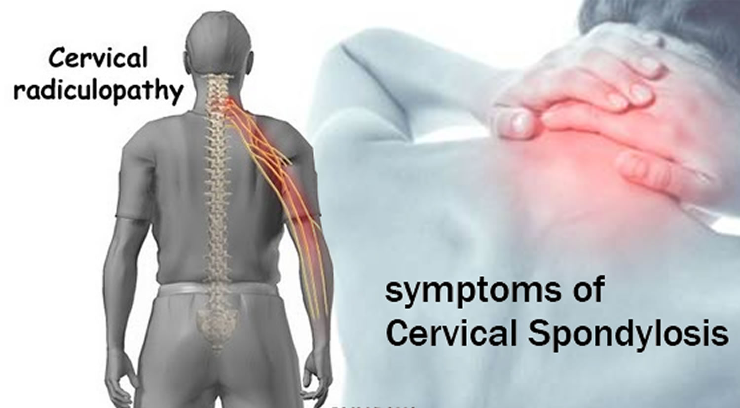 thesis on cervical spondylosis