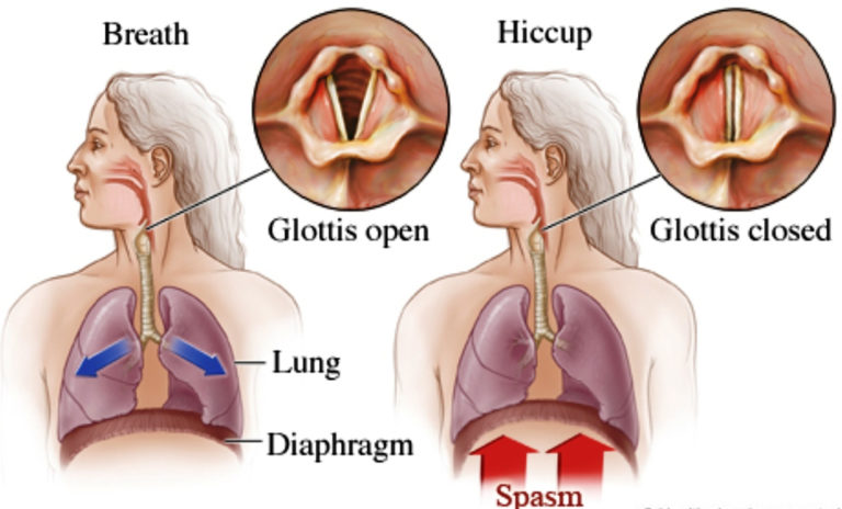 Hiccups Causes Learn How To Stop Get Rid And Prevent Hiccups   Hiccups 768x464 