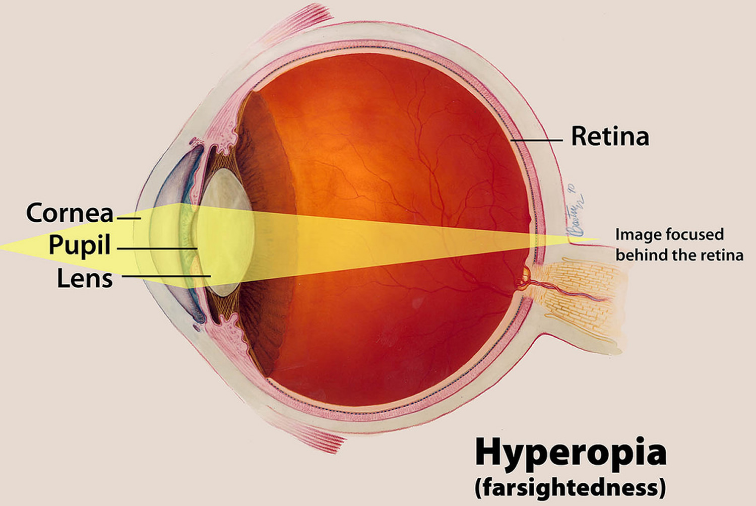 A hyperopia myopia fogalma
