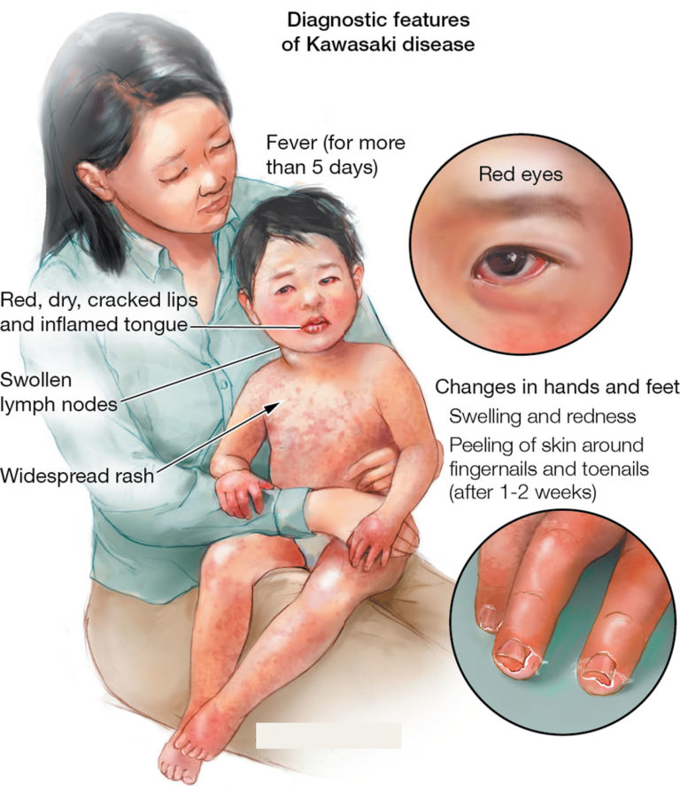 Kawasaki Disease Causes Signs Symptomstreatment 1386