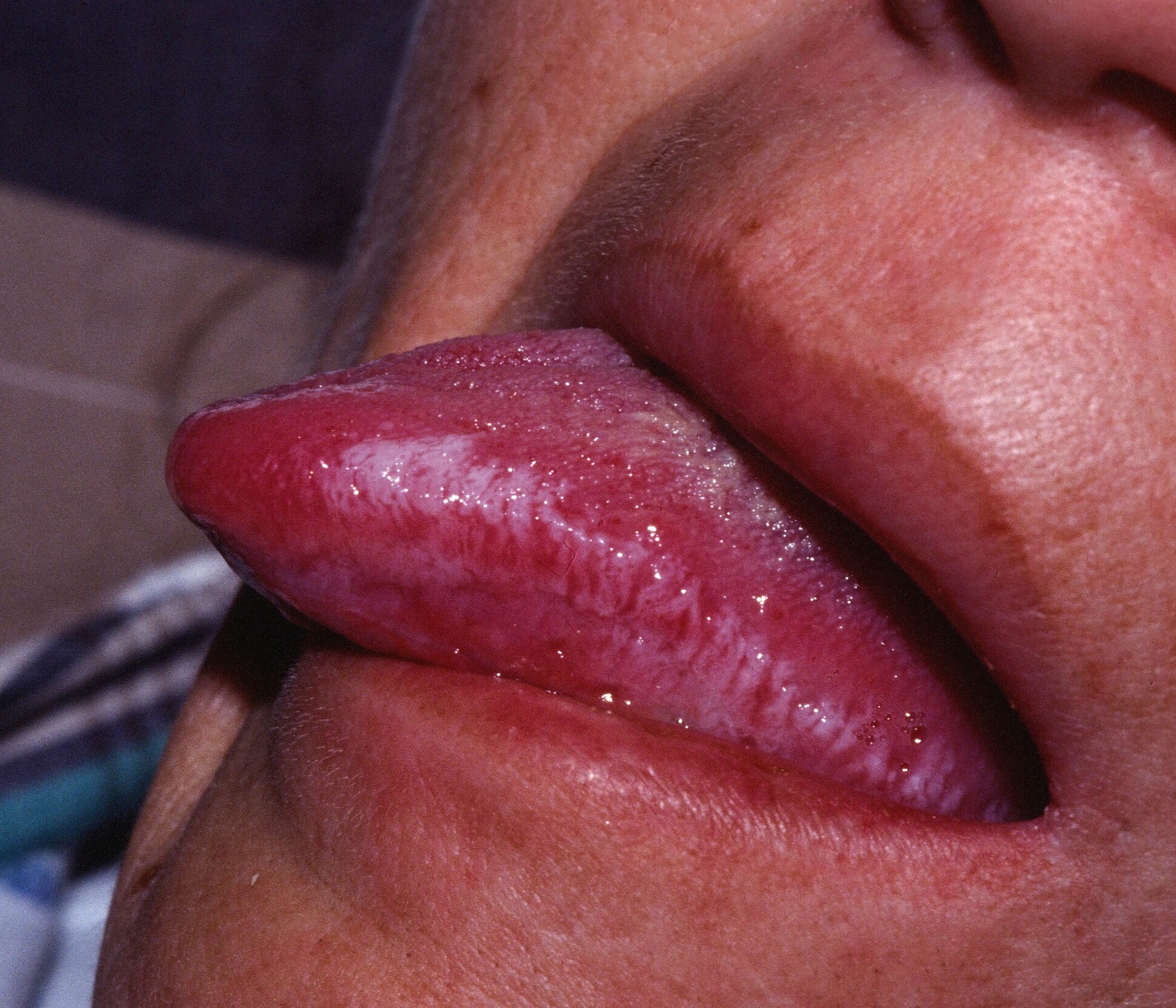 Leukoplakia tongue