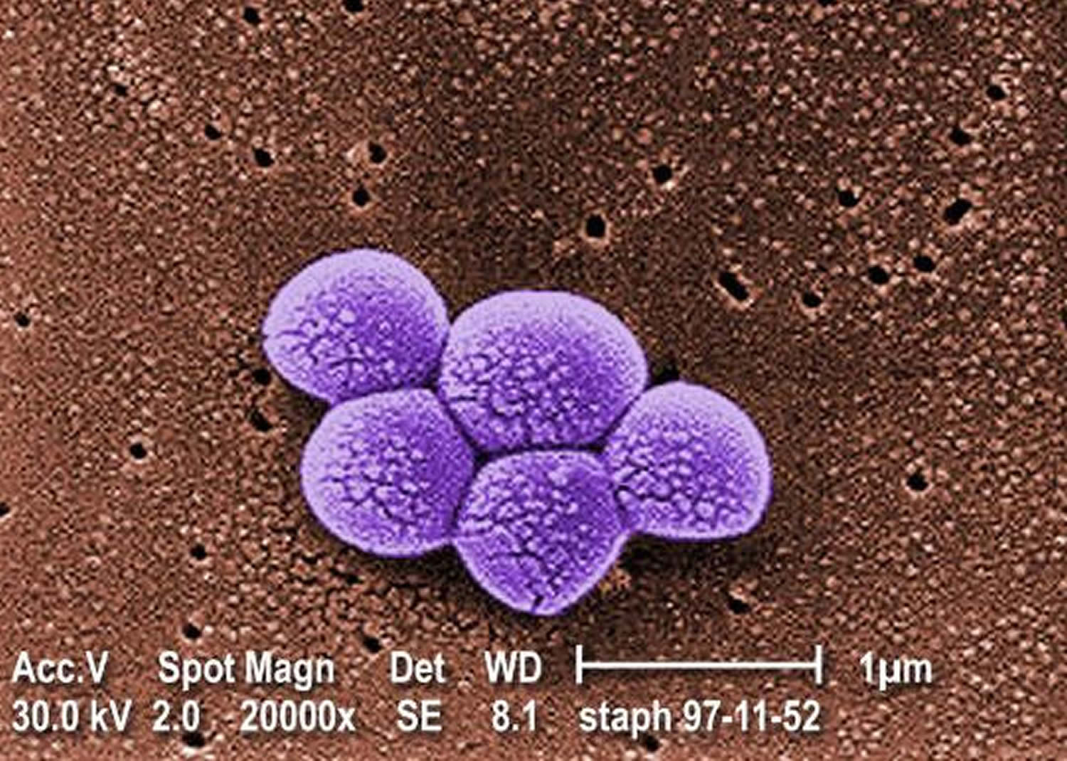 MRSA Infection - Symptoms, Diagnosis, MRSA Skin Infection Treatment