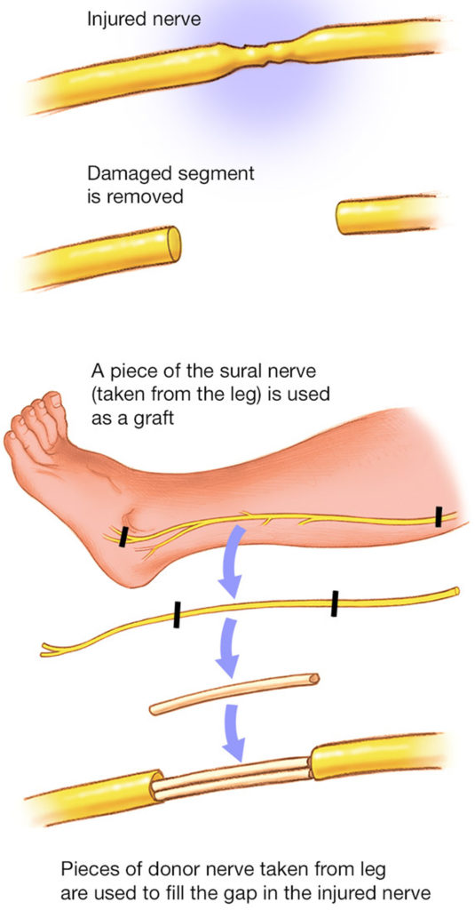 Erb's palsy causes, symptoms, diagnosis, prognosis & Erb's palsy treatment