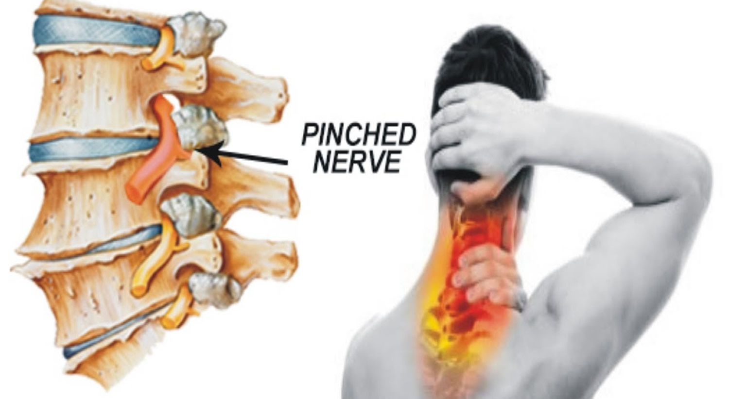opladning opføre sig identifikation Pinched Nerve - In Neck, Arm, Shoulder - Causes, Symptoms & Treatment