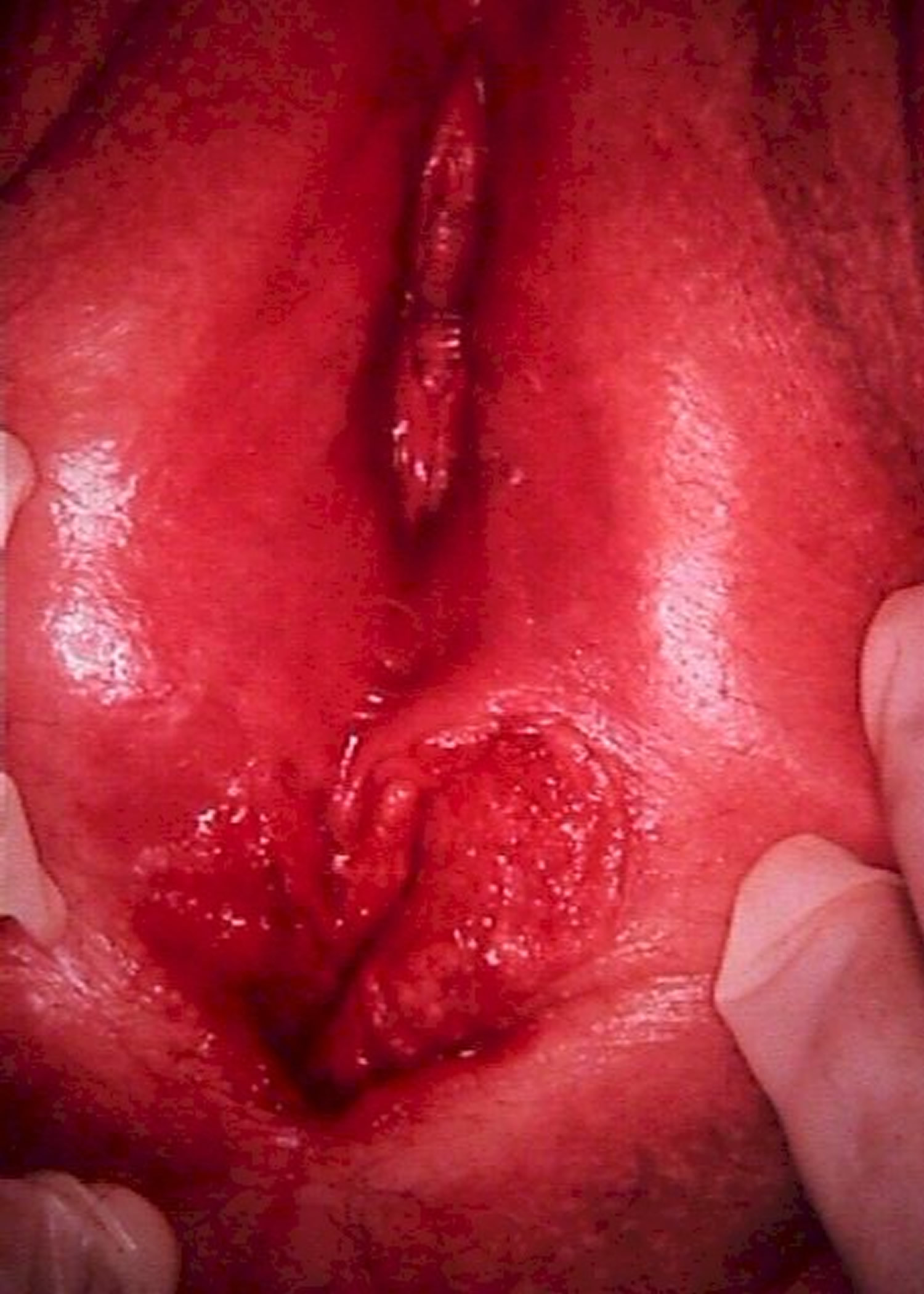 Aggressive undifferentiated carcinoma in the vagina, sweaty sex girls