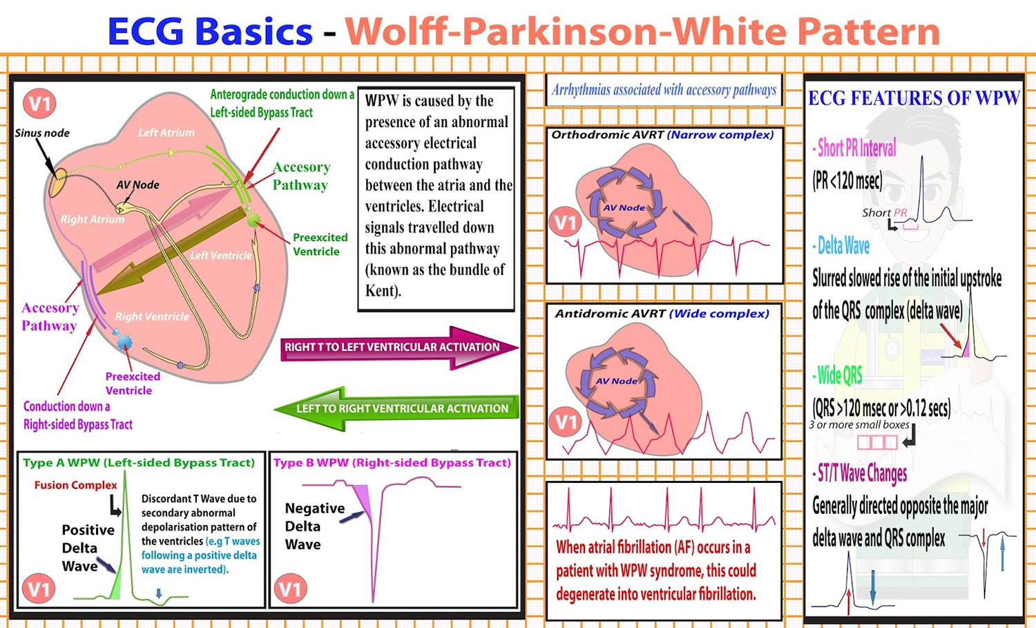 Wolff Parkinson White Syndrome - Causes, Symptoms, Treatment