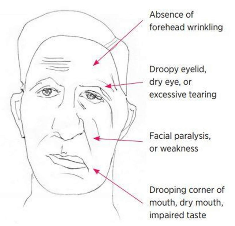 Bells Palsy Causes Symptoms Diagnosis Recovery And Treatment 1085