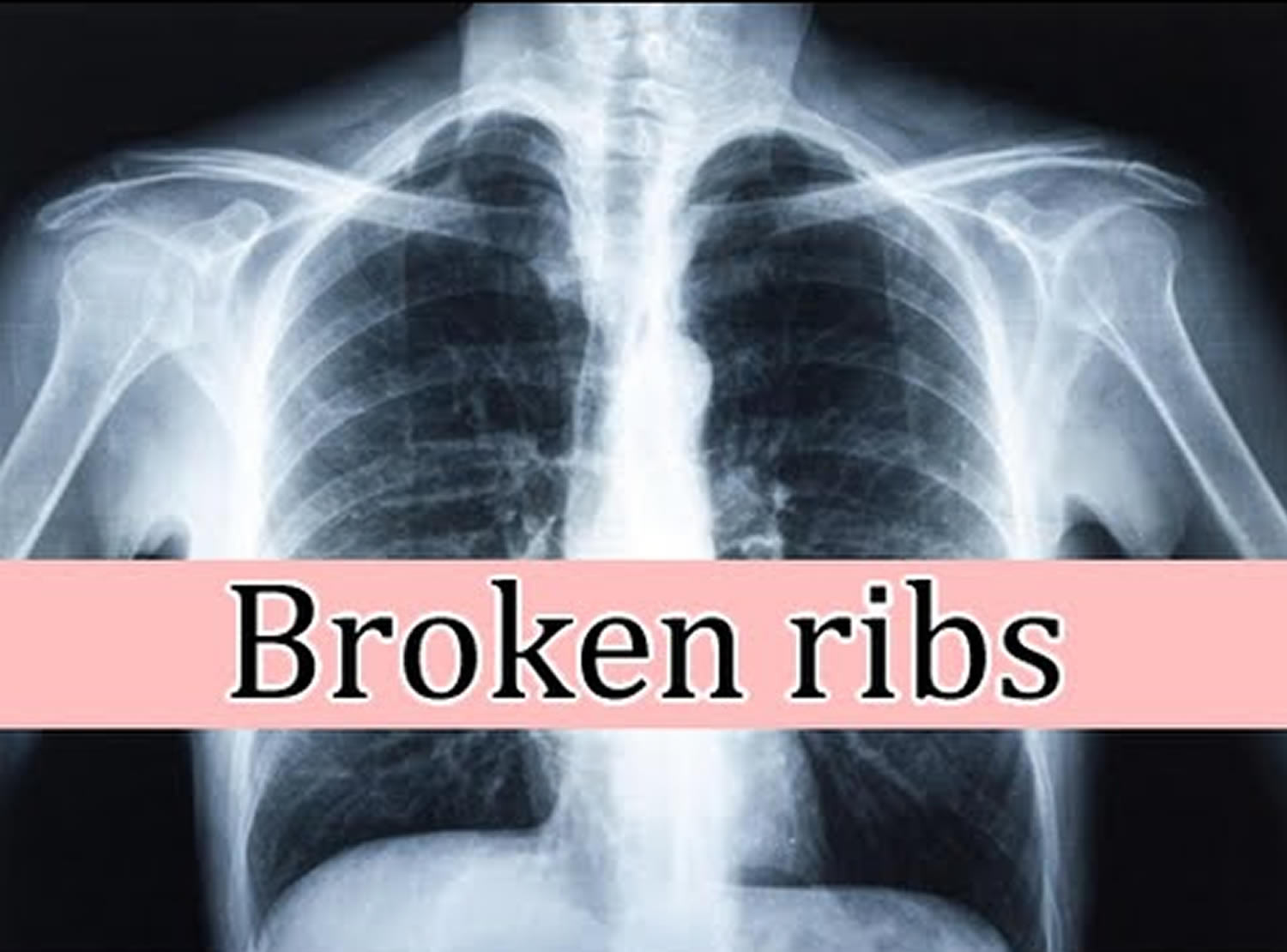 Broken Rib Causes, Signs, Symptoms, Recovery Time
