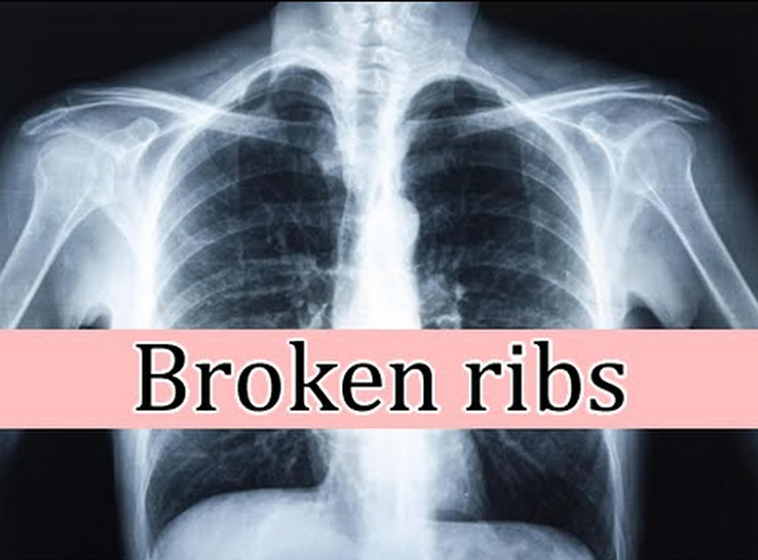 broken rib punctured lung