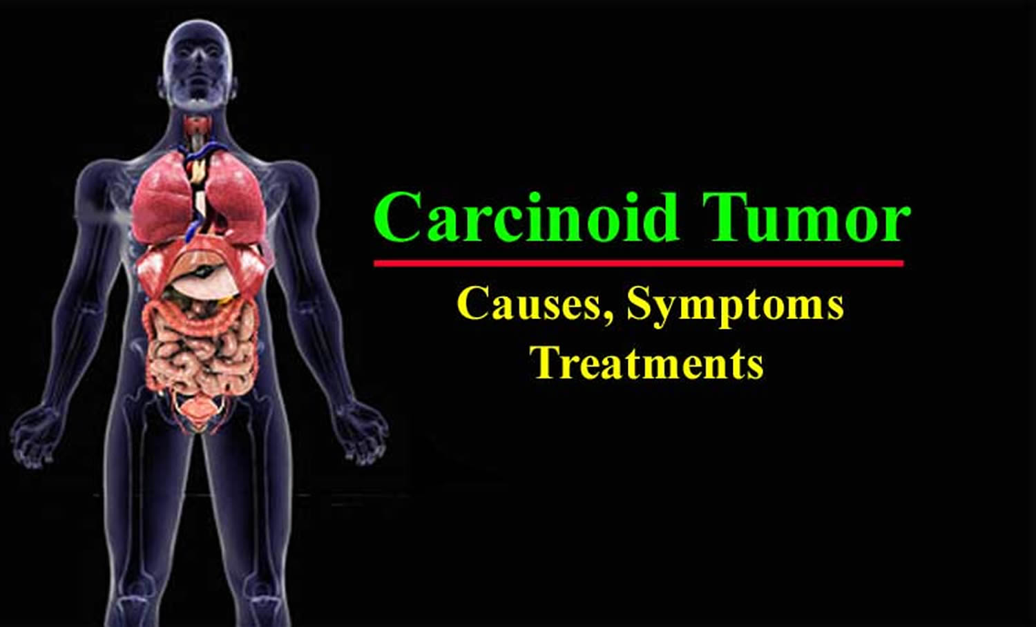 carcinoid syndrome