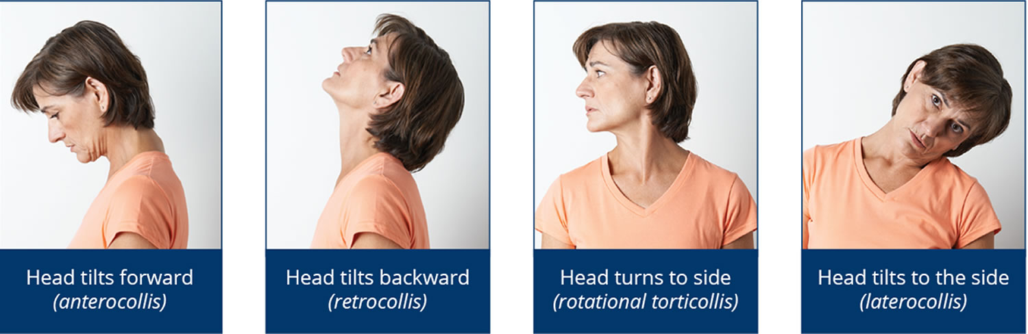 Spasmodic Torticollis Cervical Dystonia Get Images