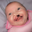 cleft-lip-and-cleft-palate