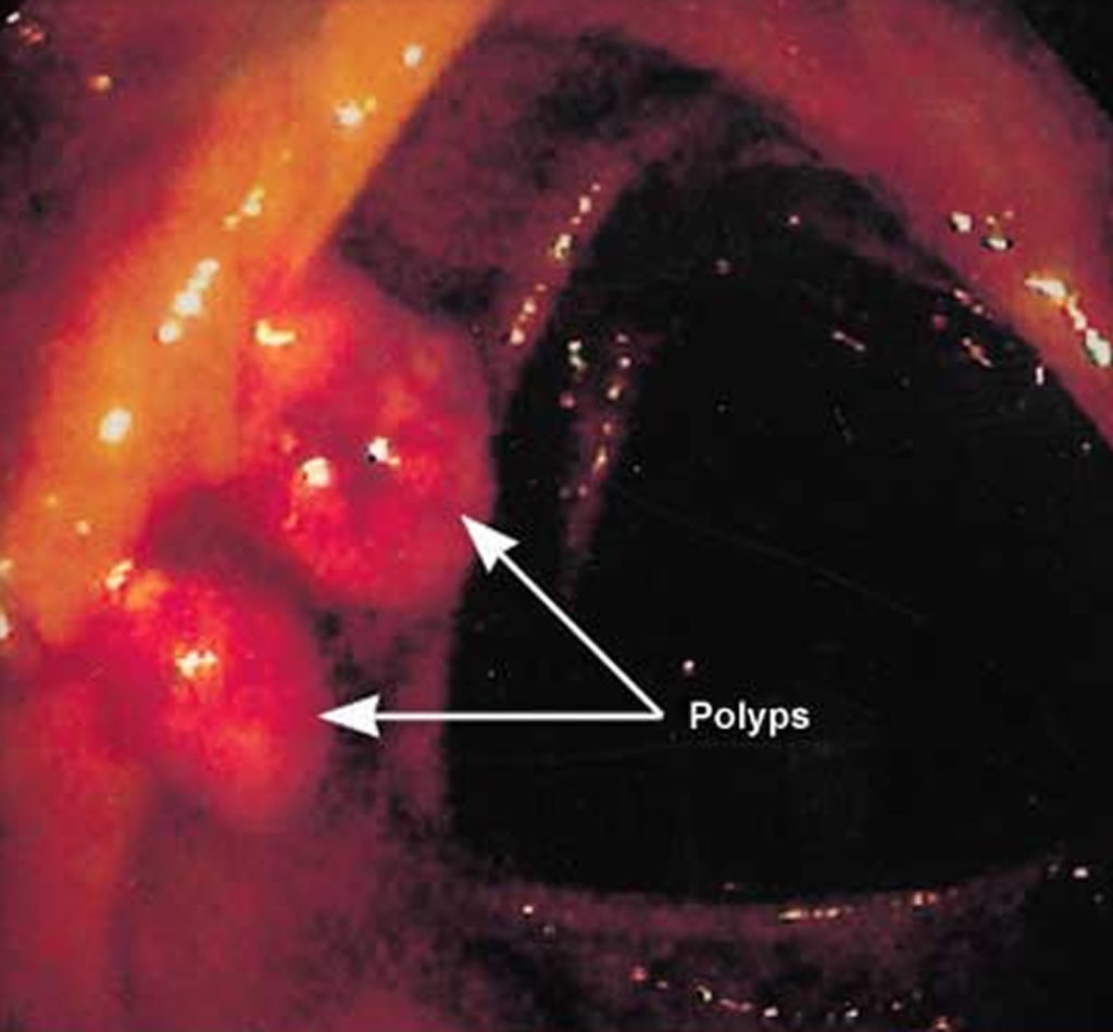Familial Adenomatous Polyposis Causes, Symptoms, Treatment
