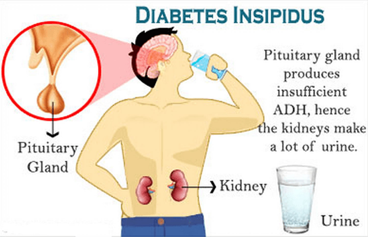 central diabetes insipidus anterior pituitary gland