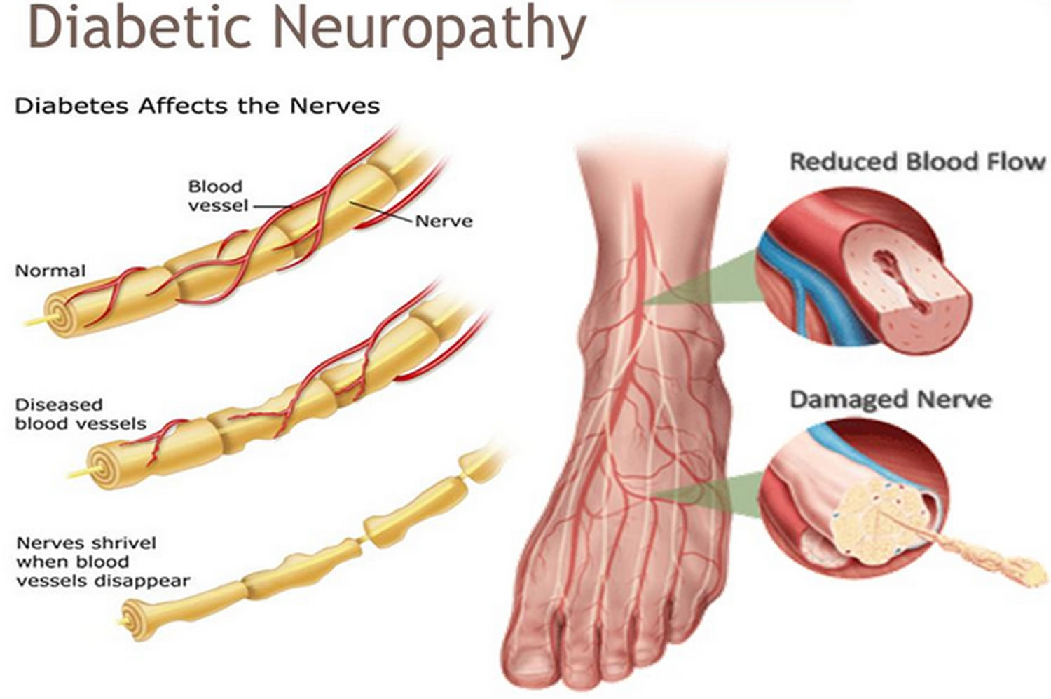 What Is Peripheral Neuropathy In Diabetes