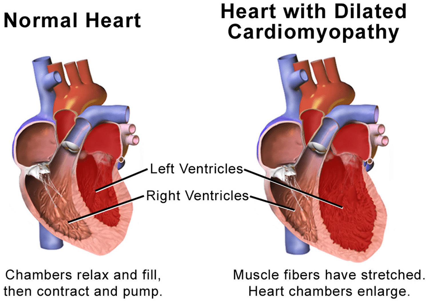 How Serious Is Dilated Left Atrium