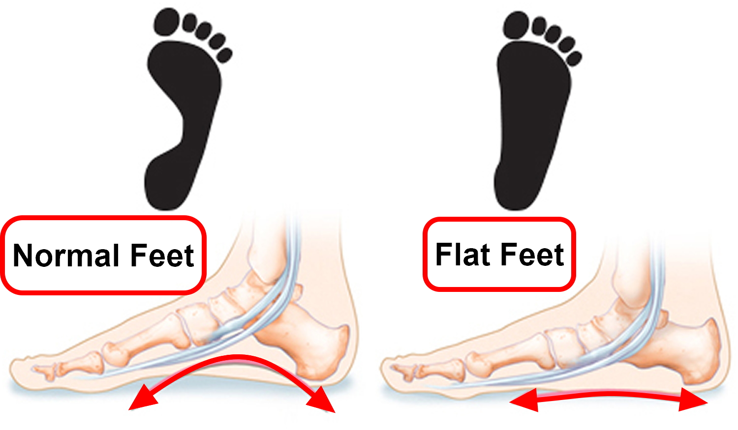 Flat Feet - Causes In Adults & Children, Symptoms, Exercises & Treatment