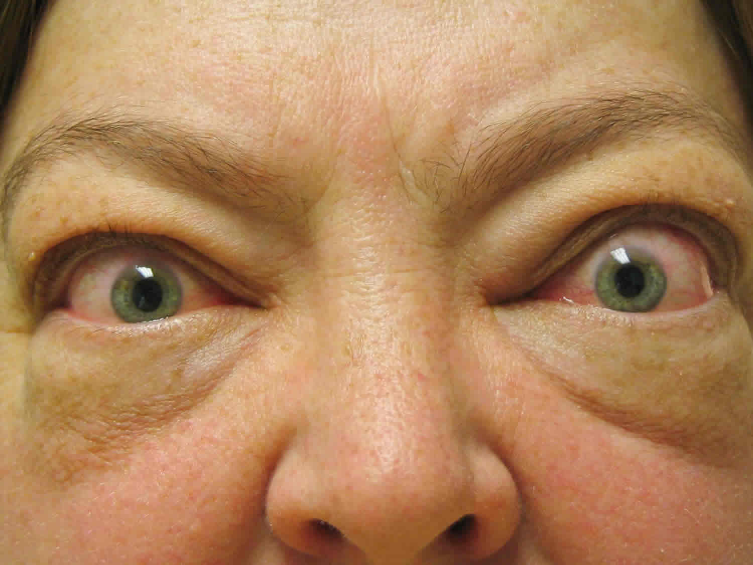 graves-disease-pictures