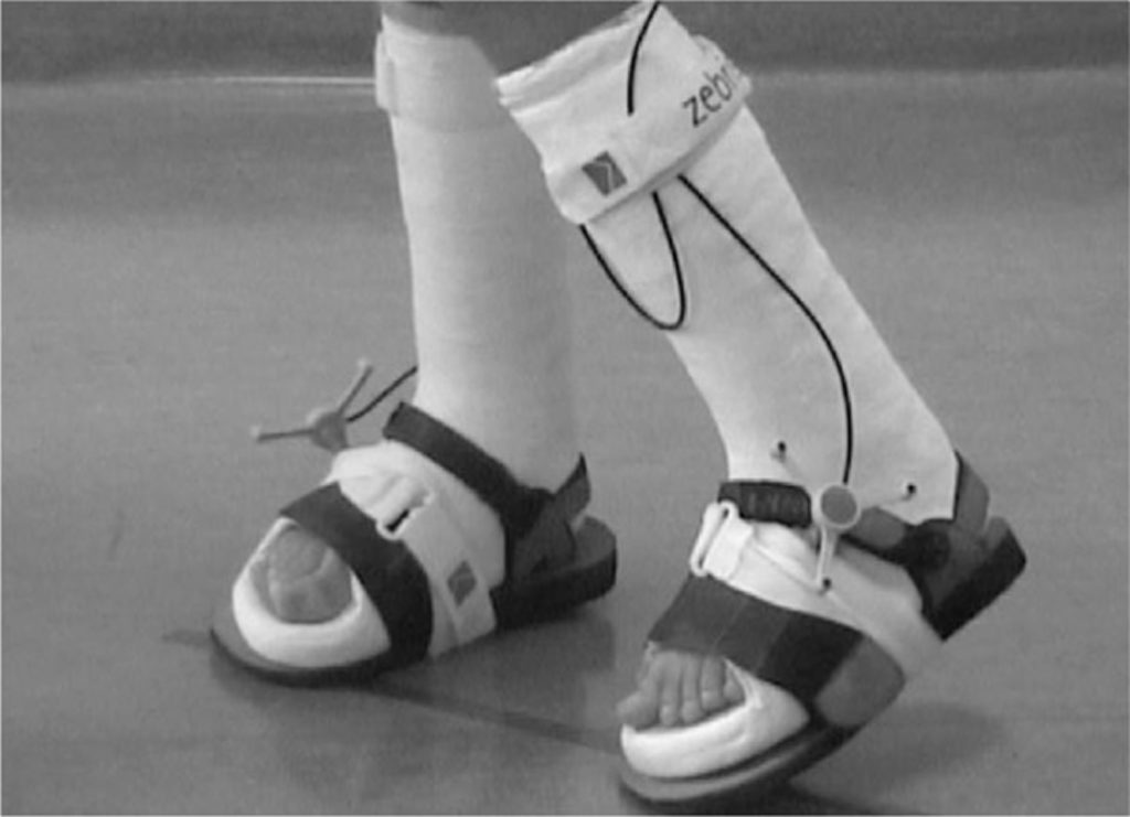 Toe Walking Causes, Idiopathic Toe Walking, How To Stop Toe Walking