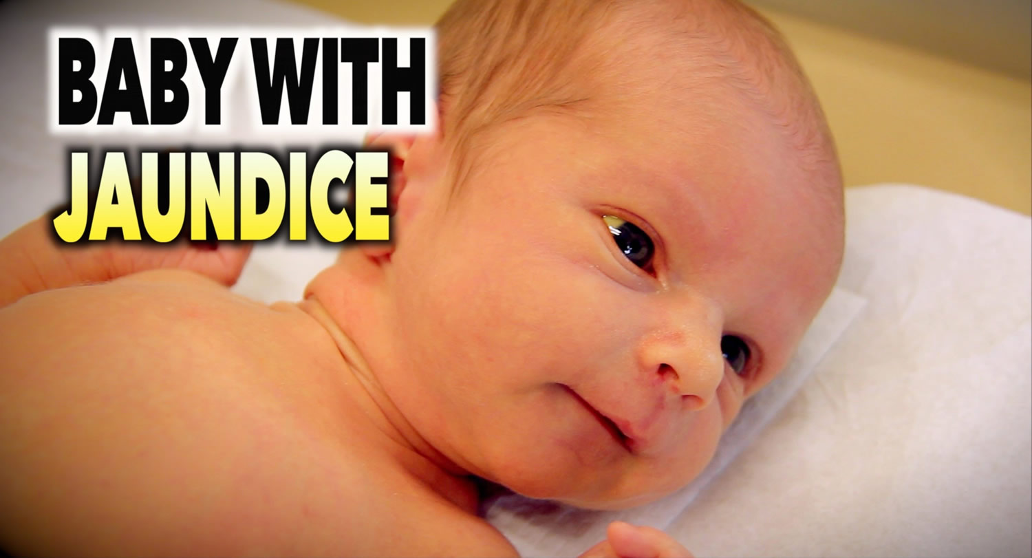 jaundice-in-newborns-causes-signs-symptoms-diagnosis-treatment