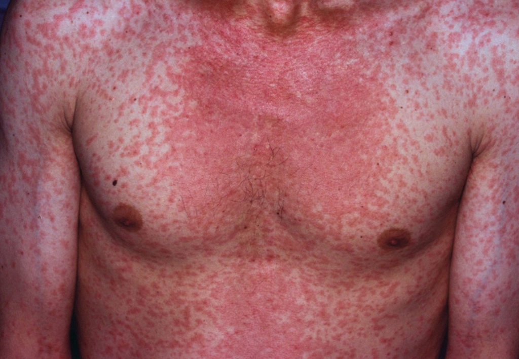 Measles - Causes, Rash, Symptoms, Signs, Measles Treatment