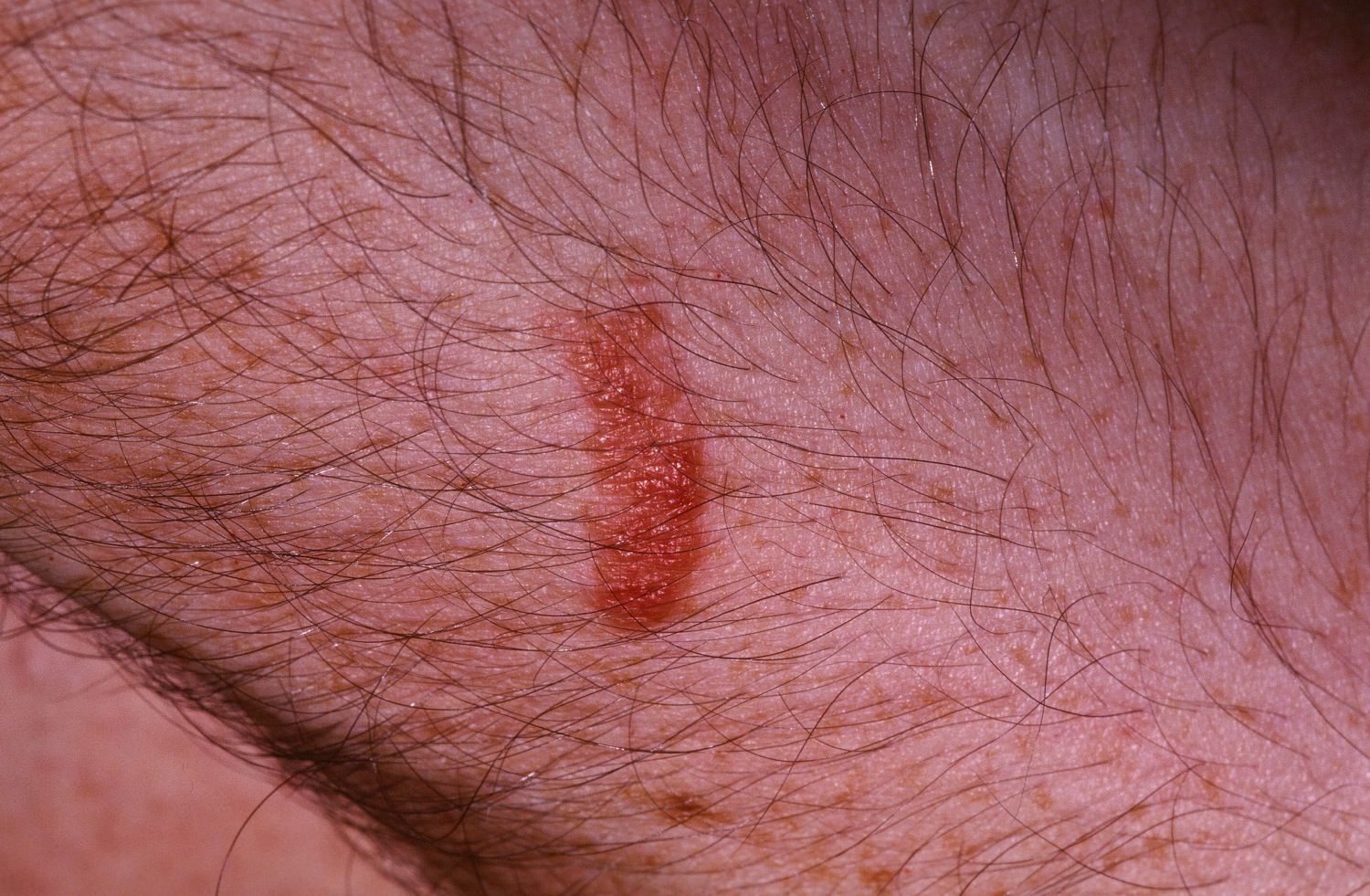 Poison Ivy Rash Causes, How To Identify Poison Ivy Rash & Treatment