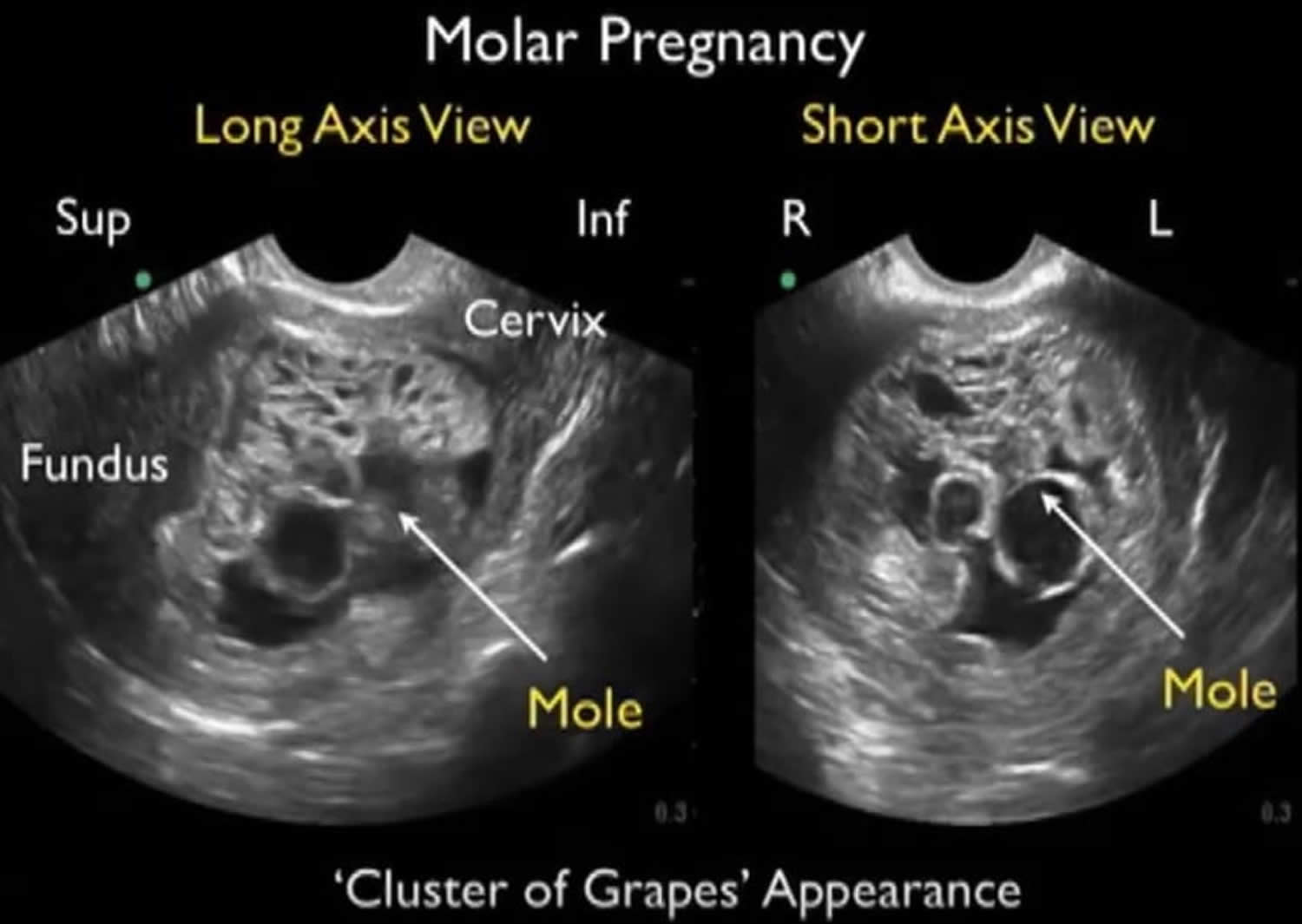 presentation of molar pregnancy