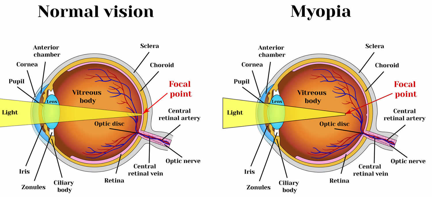 What Causes Vision Problems At Night