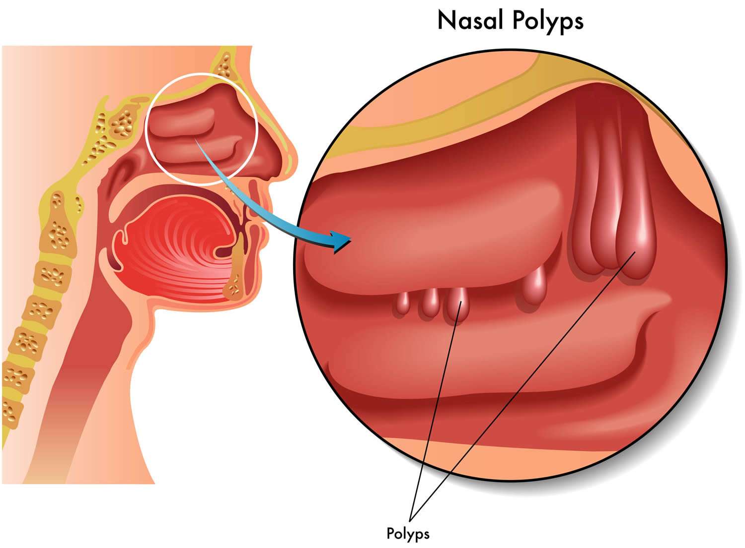 Nasal Polyps Causes Symptoms Home Remedies Treatment