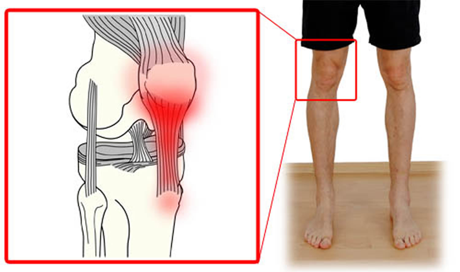 what-is-a-patellar-tendon-tear-symptoms-treatment-and-recovery