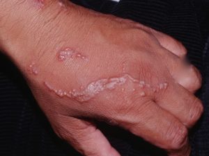 Poison Ivy Rash - Causes, How To Identify Poison Ivy Rash & Treatment