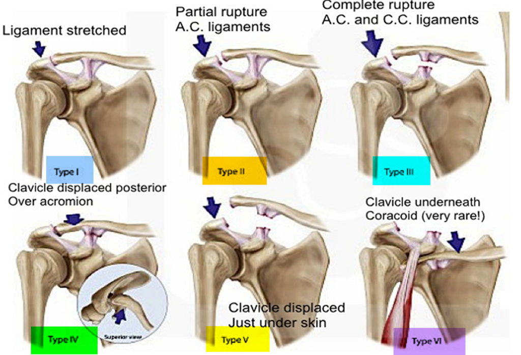 Separated Shoulder Causes Symptoms Exercises Treatment