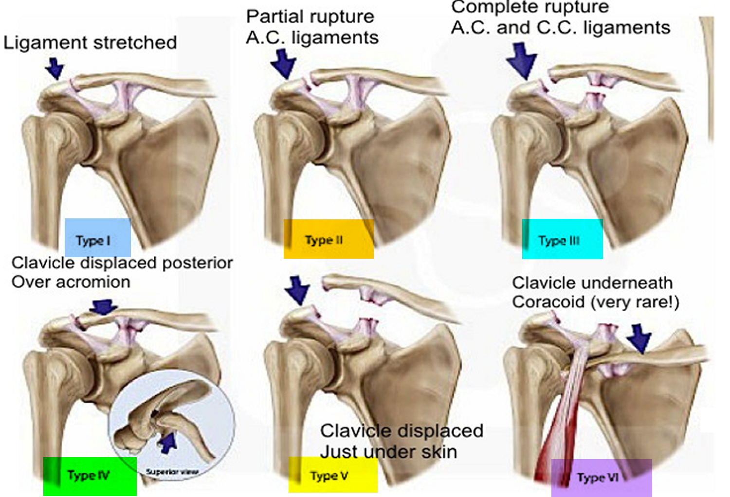 Separated Shoulder Causes, Symptoms, Exercises, Treatment
