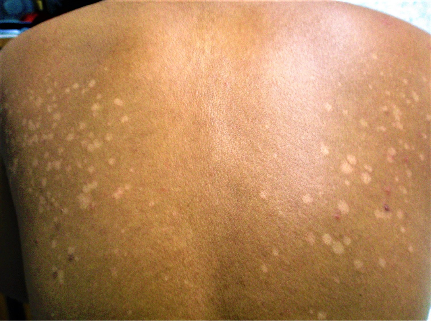 Tinea Versicolor - Causes, Signs, Symptoms, Treatment & Remedies