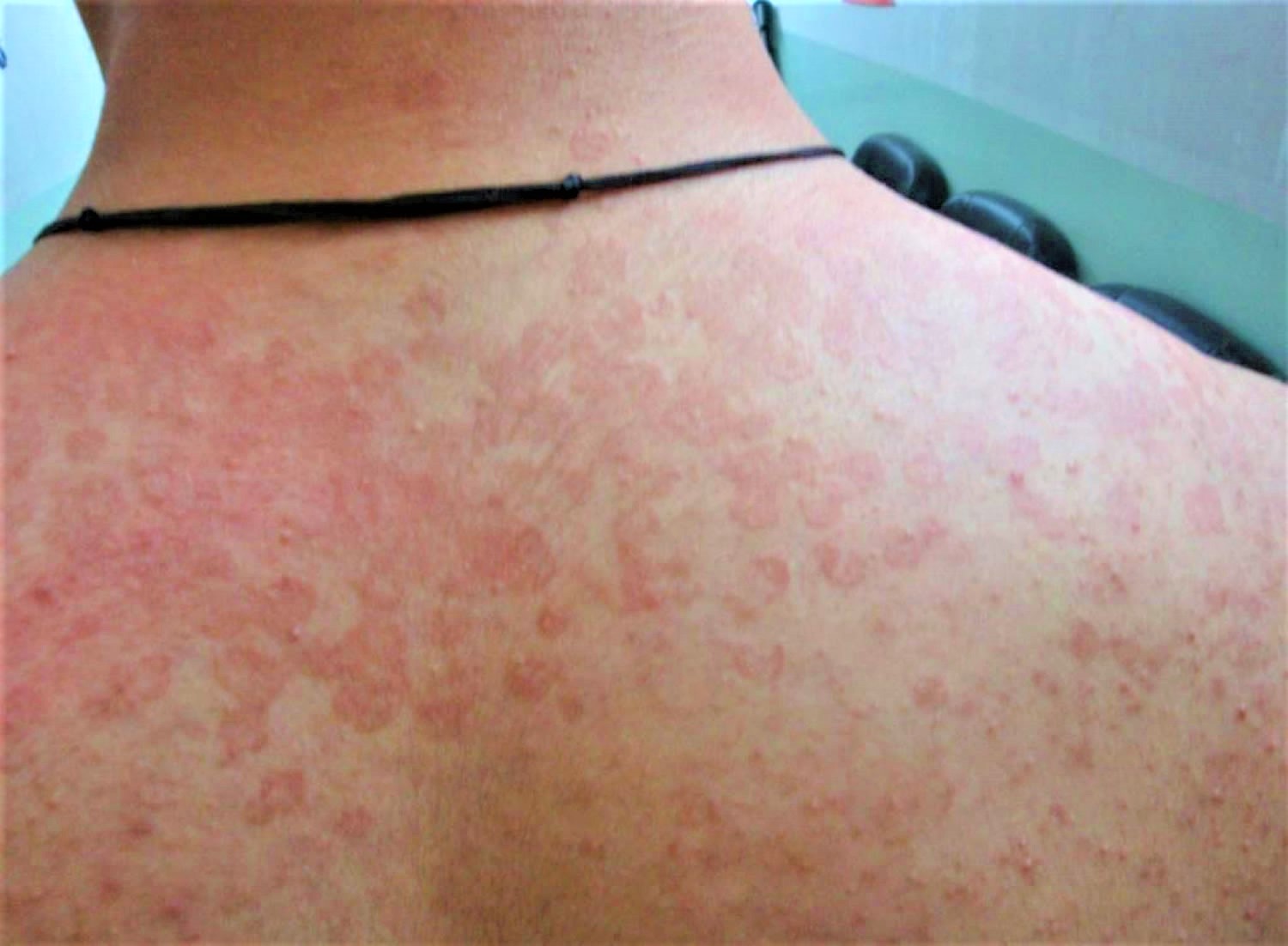 Tinea Versicolor Causes Signs Symptoms Treatment Remedies