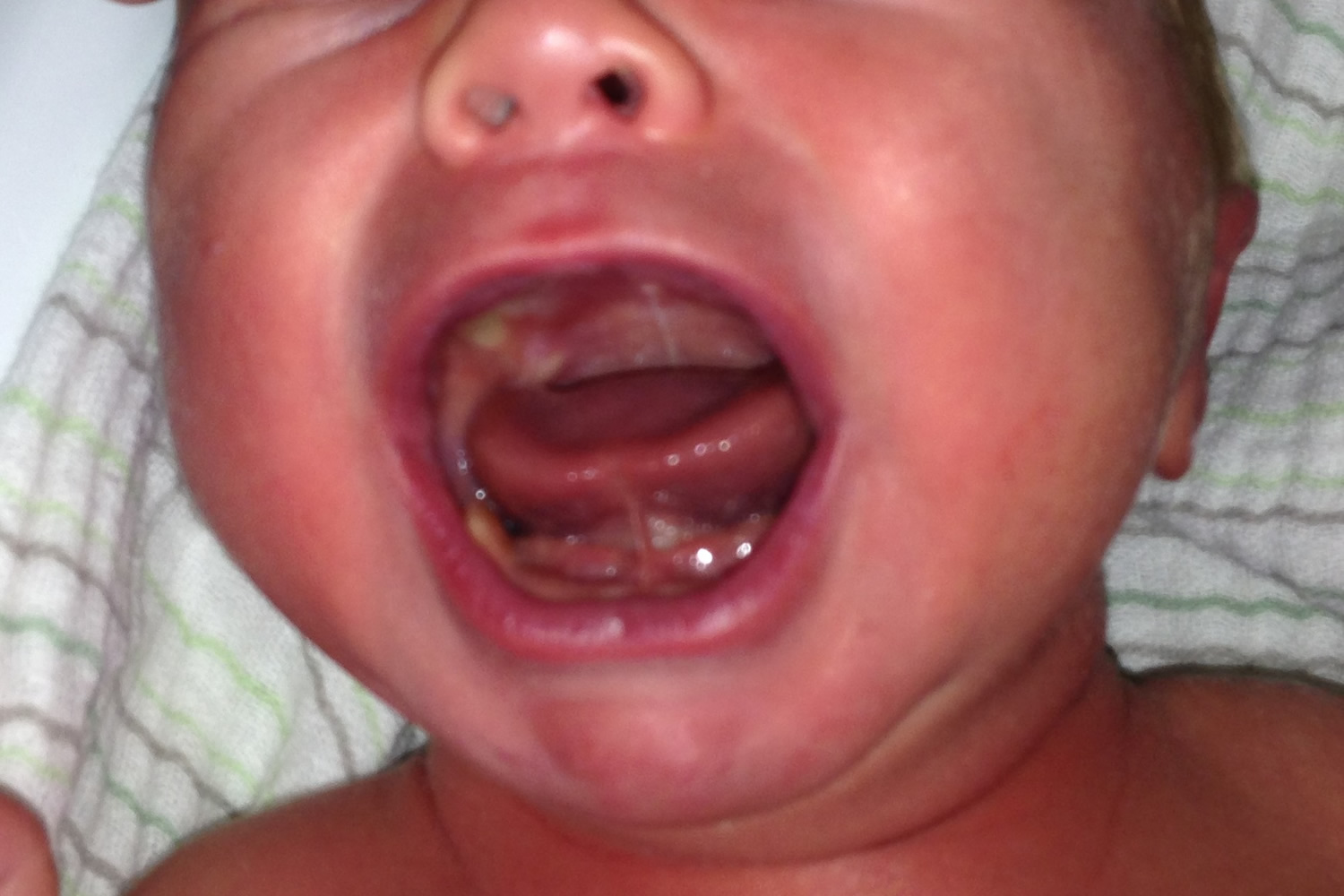 tongue-tie-ankyloglossia-infant-newborn-causes-treatment