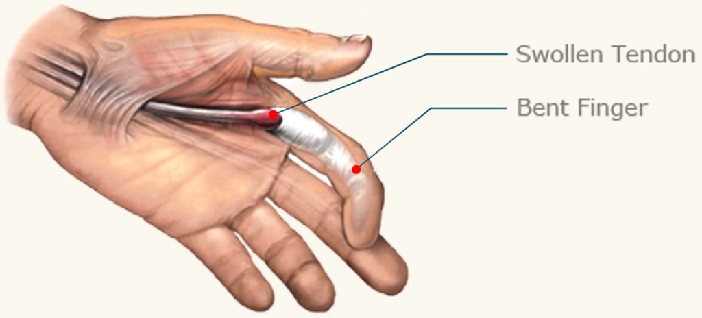 Trigger Finger - Causes, Symptoms, Splint, Exercises, Treatment