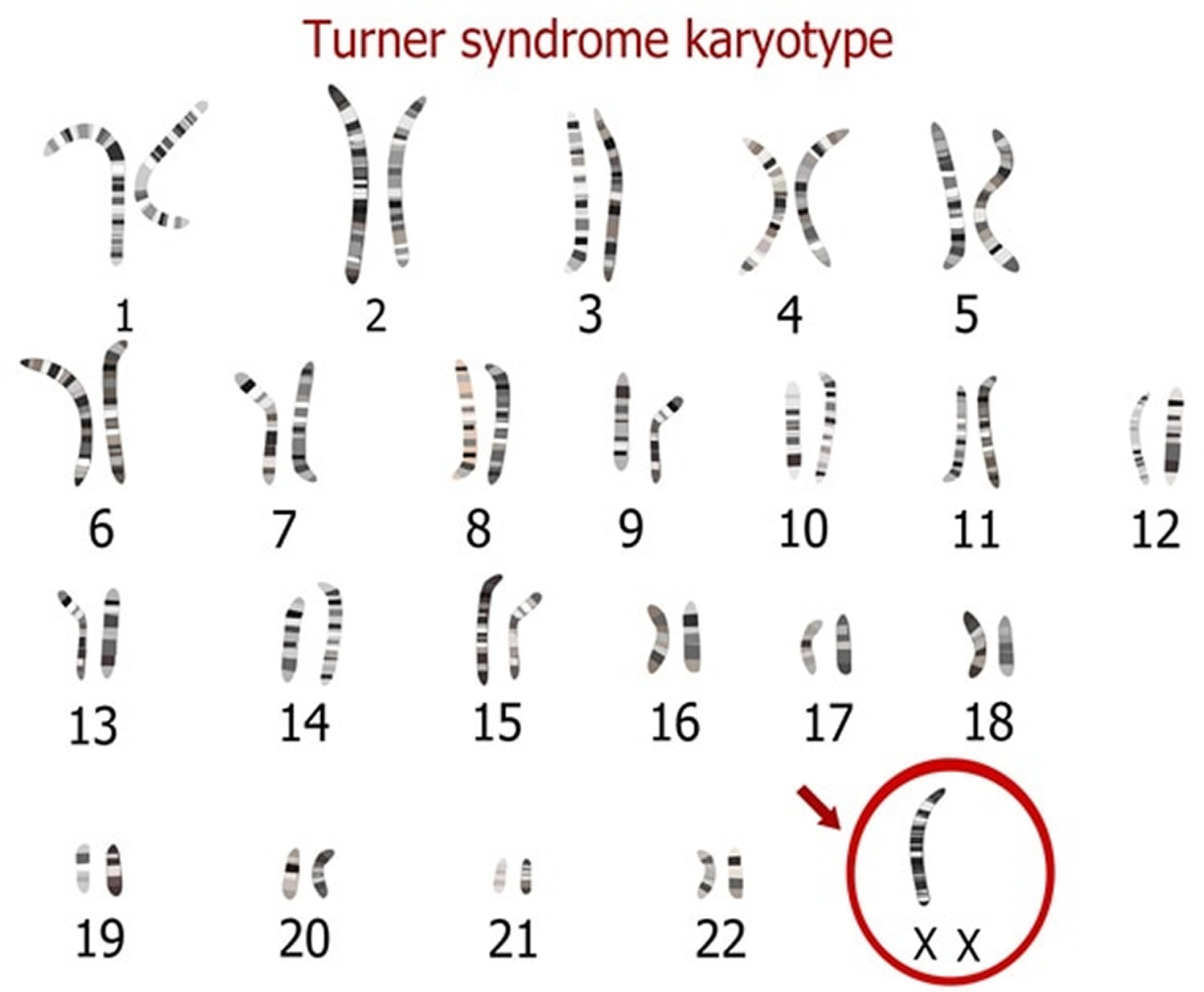 Turner Syndrome Causes, Symptoms, Life Expectancy, Treatment