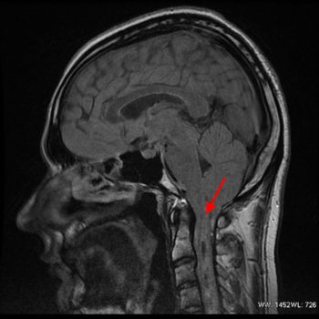 Syringomyelia - Causes, Symptoms, Prognosis, Treatment