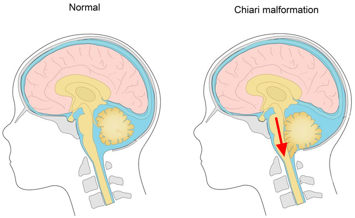 Syringomyelia Causes Symptoms Prognosis Treatment 0537