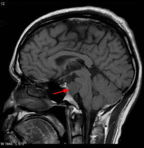 Chordoma Cancer - Causes, Symptoms, Life Expectancy, Treatment