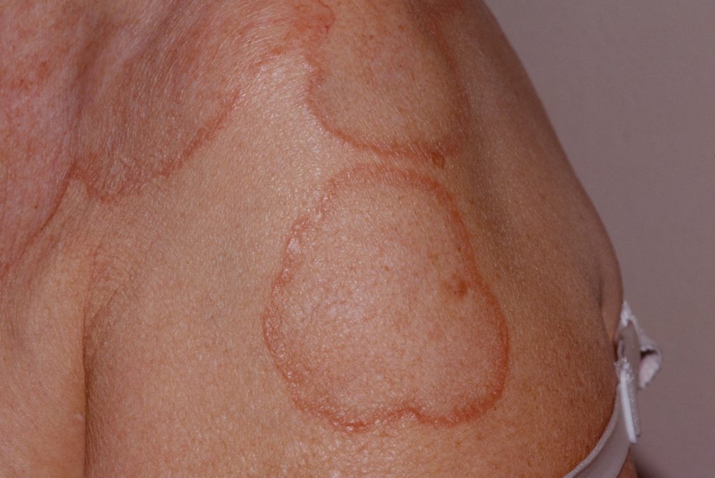 Granuloma Annulare Causes, Rash, Treatment