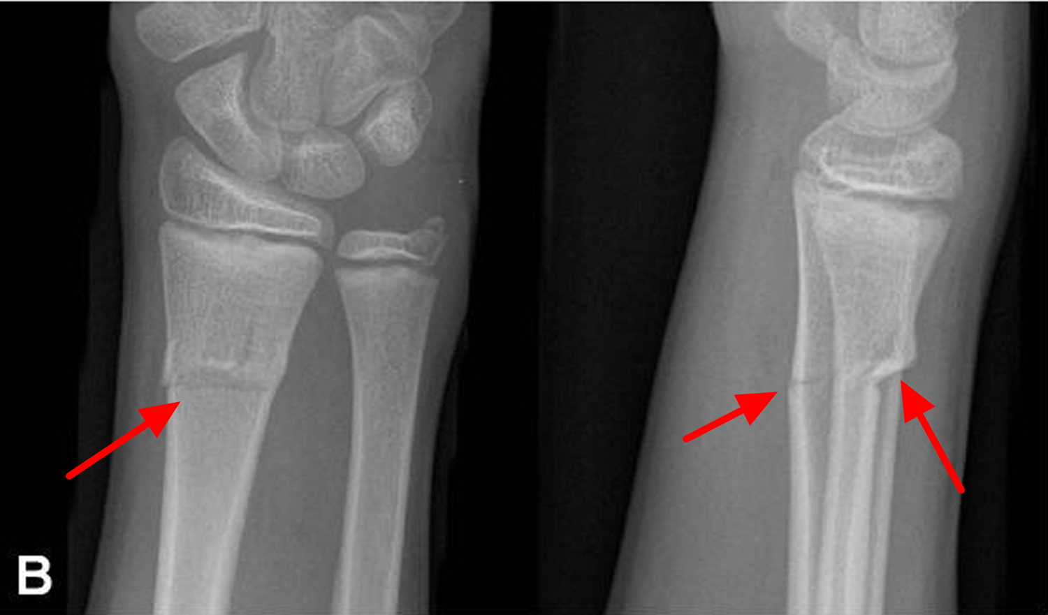 greenstick fracture distal radius